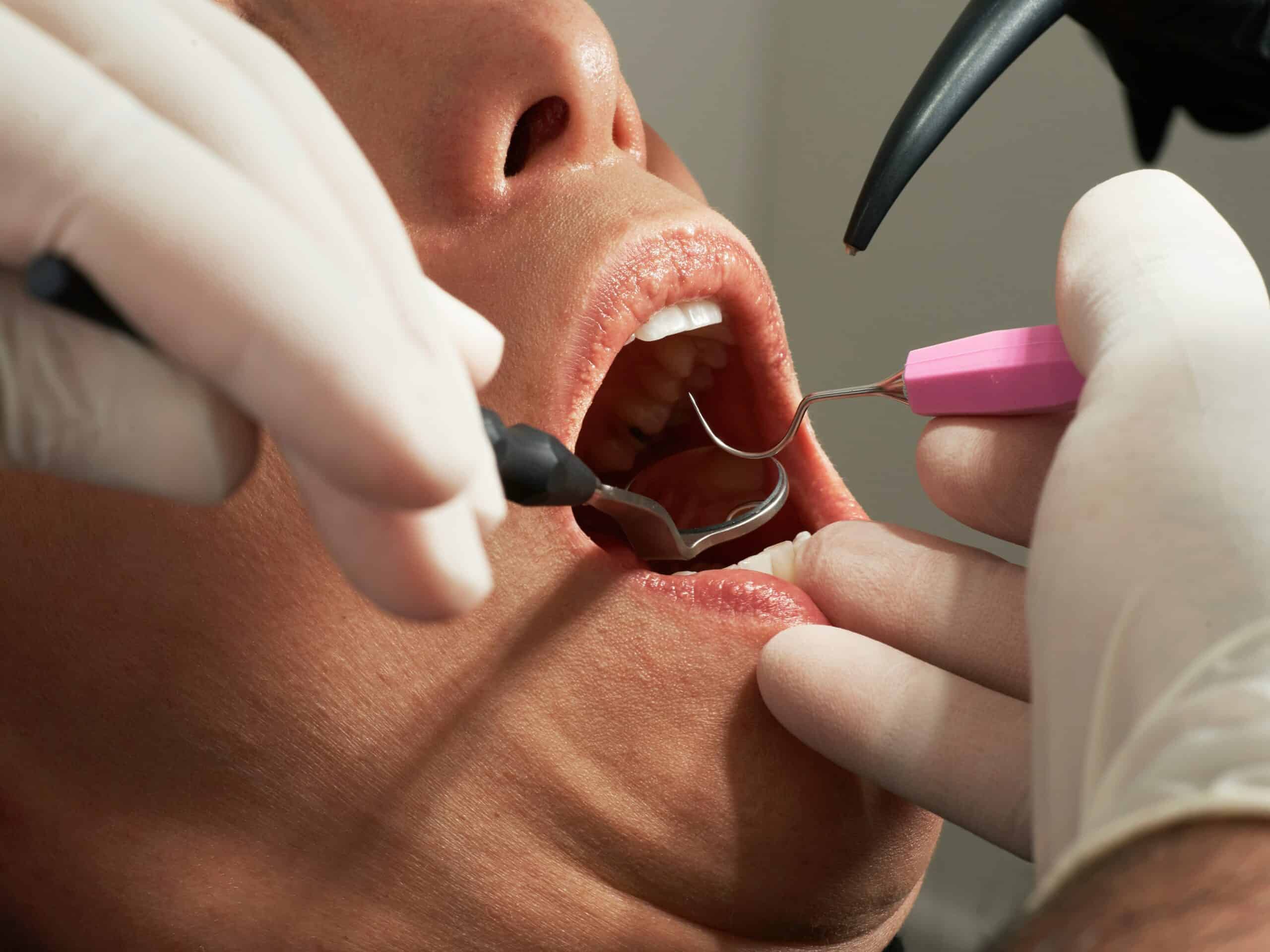 Person having dental work done to their mouth.